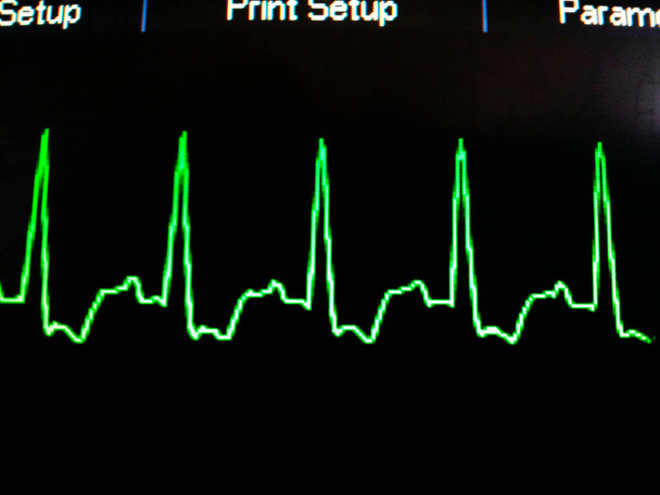 EKG Green Wave Tracing op ICU Monitor - Foto, afbeelding