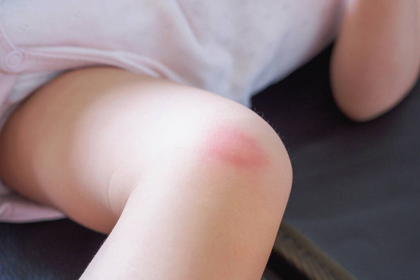 bőrkiütés és vörös foltos allergia, amelyet szúnyogcsípés okoz a térdben  - Fotó, kép