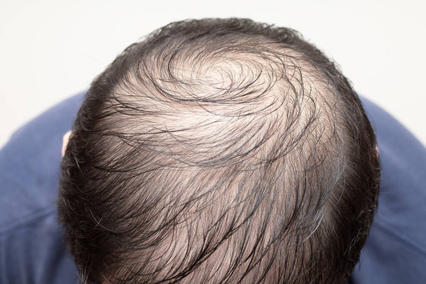閉じる白い背景に隔離された脱毛、薄毛や脱毛症を持つ男の頭の上のビューを閉じます。髪の問題.  - 写真・画像