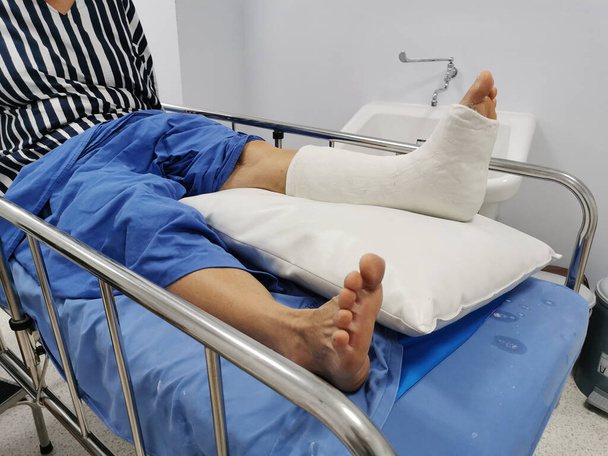 Пацієнтка з розбитою ногою від нещасного випадку на ліжку для престарілих у лікарні. Нога перев'язана в гіпсовій плівці для перелому ноги та щиколотки
.  - Фото, зображення