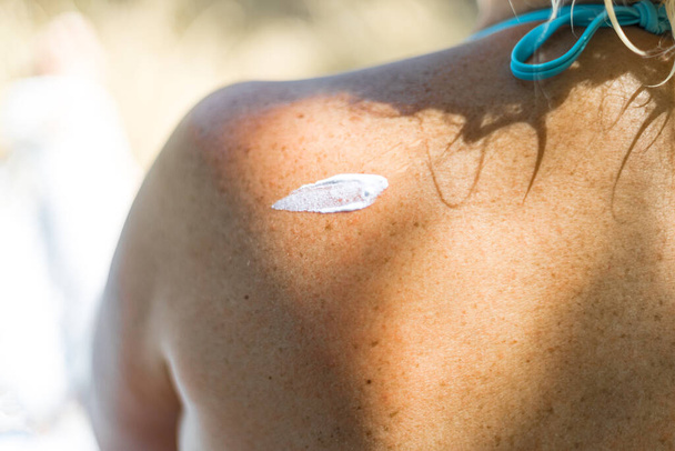 Aurinkosuojavoide valkoinen kerma tai voide ihmiskehon olkapäällä. Ihmisen ihon UV-suoja, ihosyöpä - Valokuva, kuva