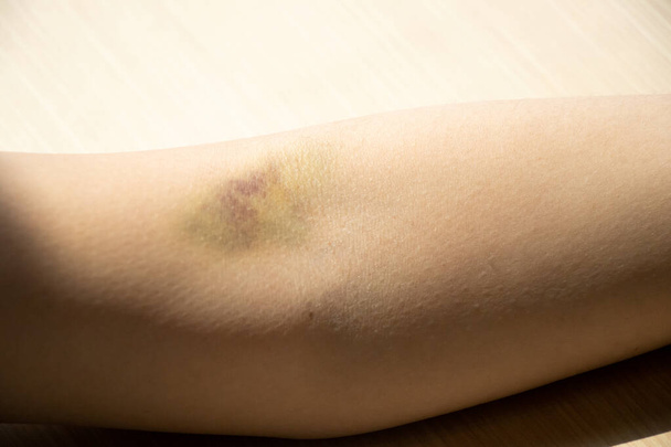 Τραυματισμός μώλωπα στο γυναικείο φόντο του βραχίονα - Φωτογραφία, εικόνα