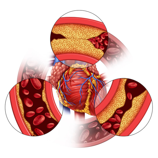 Heart artery disease and coronary medical concept as gradual plaque formation resulting in clogged arteries and atherosclerosis as human anatomy with cholesterol with 3D illustration elements. - Photo, Image