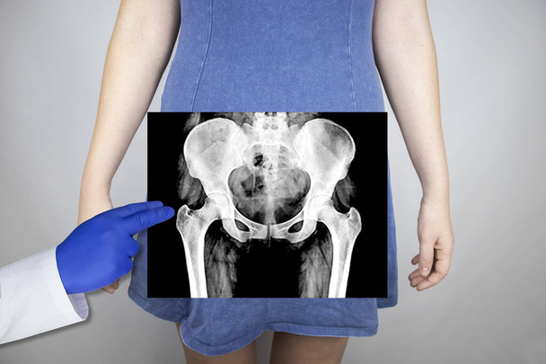 Рентген тазовых костей женщины. Радиолог осматривает рентгеновские снимки. Картинка тазобедренного сустава накладывается на тело пациента. - Фото, изображение