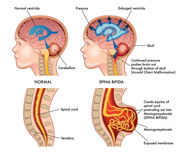 Medizinische Illustration zeigt ein Kind in zwei Situationen, links gesund und rechts von Spina bifida befallen mit Anmerkungen, die die Symptome der Pathologie erklären. - Vektor, Bild