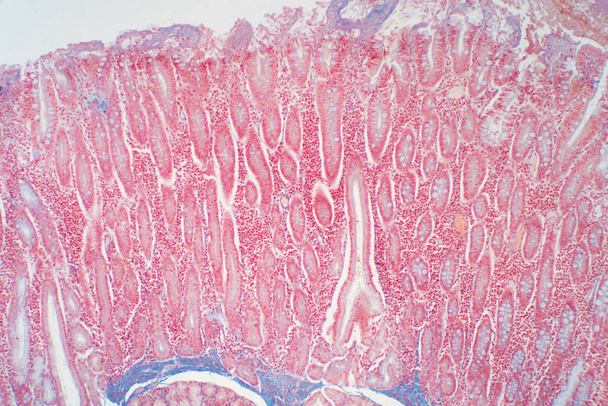 Biopsie du duodénum provenant de la pathologie de l'intestin grêle. Éducation à l'histologie humaine. - Photo, image
