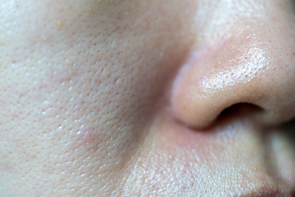 Soft focus punti neri acne sulla pelle del naso e macchia pigmentazione melasma sul viso donna asiatica. - Foto, immagini