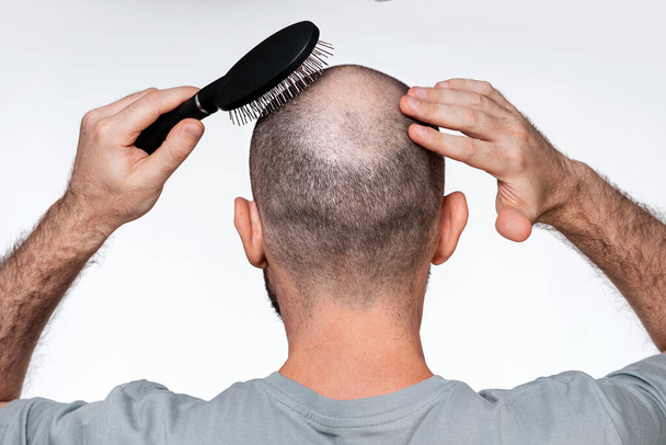 Egy férfi a kezét a kopasz fejéhez szorítja, fésülködve az alopecia fokát egy fésűvel. Közelről. Visszapillantás. A kopaszság és a férfi alopecia fogalma. - Fotó, kép