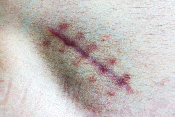 Herida en el cuerpo humano. cicatriz de cerca. costura en la piel del corte - Foto, imagen