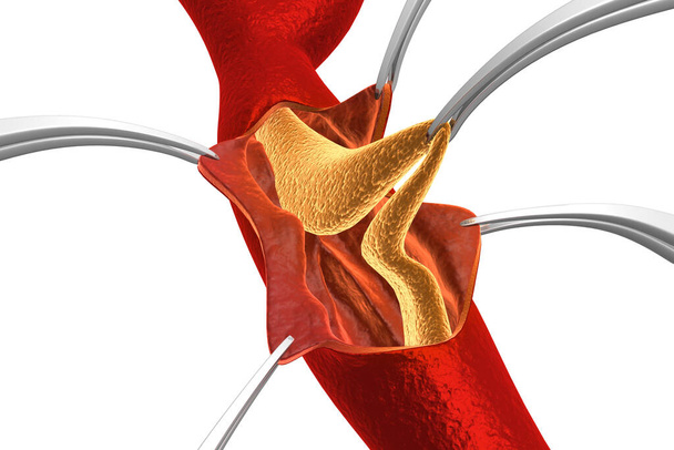 Plaque de cholestérol dans l'artère. Enlever la plaque - Photo, image