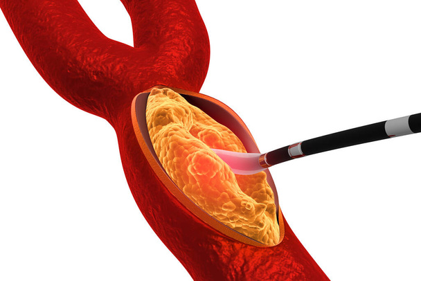 Набір холестерину в артерії. Вилучення таблички
 - Фото, зображення