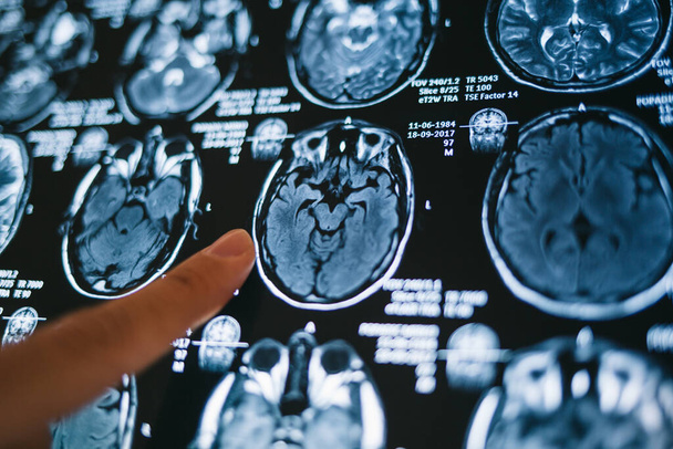 脳の磁気共鳴画像を指す。MRIヘッドスキャン。医学、科学の概念  - 写真・画像