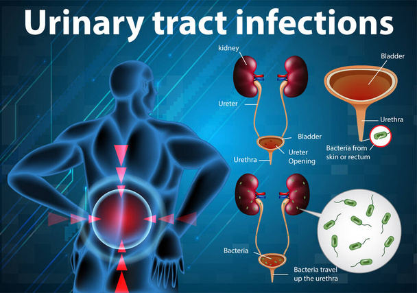 Informatieve illustratie van urineweginfecties illustratie - Vector, afbeelding