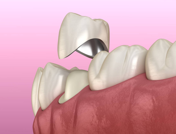 Przygotowany ząb przedtrzonowy i korona metalowo-ceramiczna. Medycznie dokładna ilustracja 3D - Zdjęcie, obraz