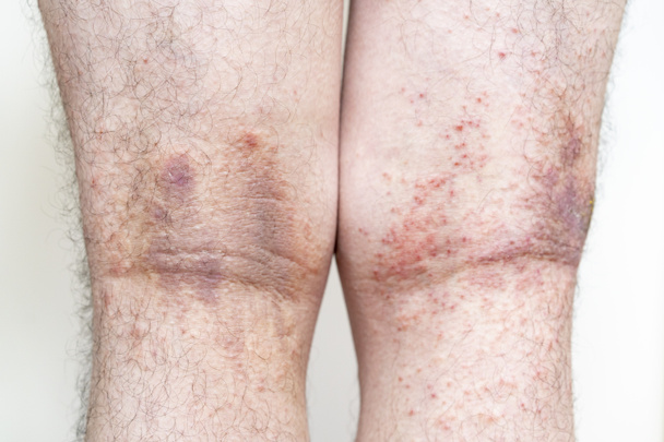 膿の激しい湿疹（成人男性の足）) - 写真・画像