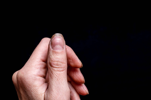 Close-up of a female thumb with a soft fossa on a nail, an overgrown cuticle, a peeling nail layer, poor manicure on a black background. Unhealthy Nail Concept - Photo, image