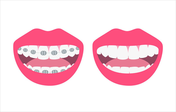 Щасливі посмішки показують до і після вирівнювання і відбілювання зубів. Вирівнювання укусу зубів, зубний ряд з брекетами, концепція ортодонтичної охорони здоров'я. Векторні ілюстрації
 - Вектор, зображення