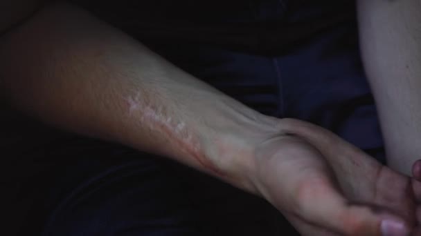 grande cicatrice sur le bras mans - Séquence, vidéo