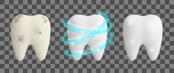 Čistý a špinavý zub. Bělení zubů. Koncepce dentálního zdravotního designu. Realistická vektorová ilustrace. - Vektor, obrázek