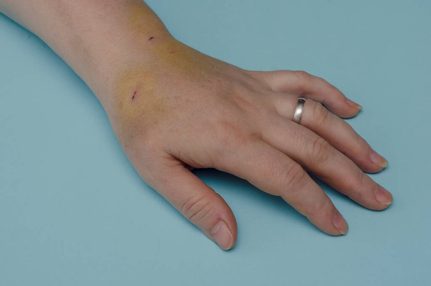 Рука белой женщины средних лет с синяками и ранами. Женщина демонстрирует гематомы и повреждения кожи. Бытовое насилие или несчастный случай. - Фото, изображение