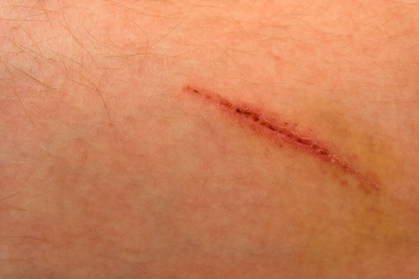 Une blessure sur le corps humain, suture vieille, coupure profonde, cicatrice gros plan, incision sur la jambe - Photo, image