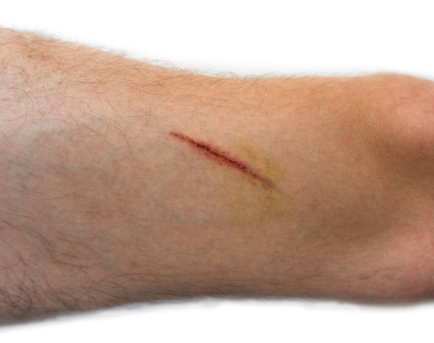Una ferita sul corpo umano, sutura vecchio, taglio profondo, cicatrice primo piano, incisione su, sfondo bianco - Foto, immagini