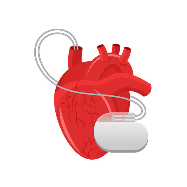 Marcapasso - coração humano e implante cardiovascular  - Vetor, Imagem