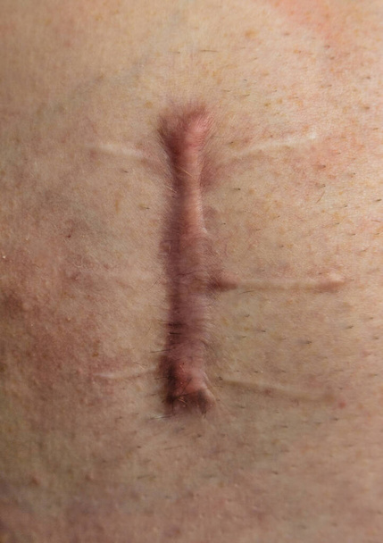 Un ferito sul corpo umano, sutura lunga, taglio profondo, cicatrice primo piano, incisione sull'addome - Foto, immagini
