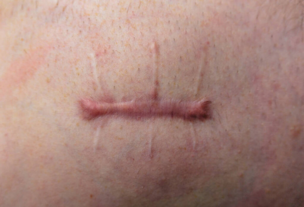 Blessé sur le corps humain, suture prolongée, coupure profonde, cicatrice en gros plan, incision sur l'abdomen - Photo, image