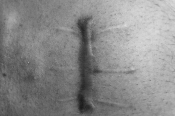 Раненый на теле человека, шов затяжной, глубокий порез, шрам крупным планом, разрез на животе - Фото, изображение