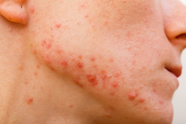 Acne skin - Photo, Image
