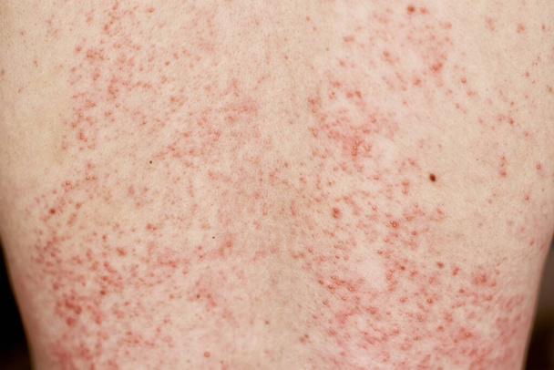 Wysypka alergiczna na skórze. Kobieta z problemami dermatologicznymi na tylnej skórze - Zdjęcie, obraz