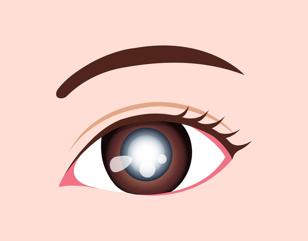 Ojo enfermedad vector ilustración / catarata - Vector, Imagen