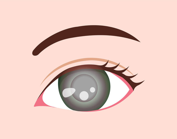 Eye disease vector illustration / Glaucoma - Vector, Image