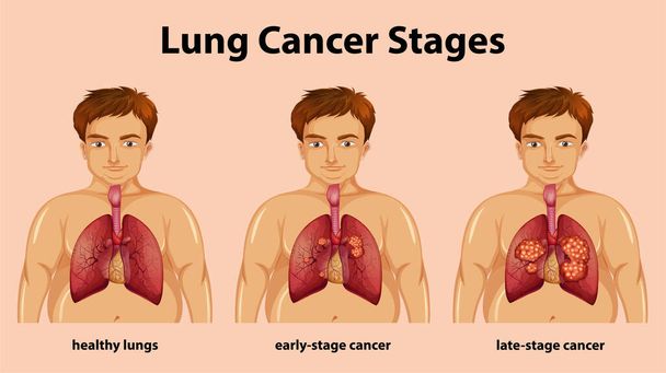 Informatieve illustratie van longkanker stadia illustratie - Vector, afbeelding