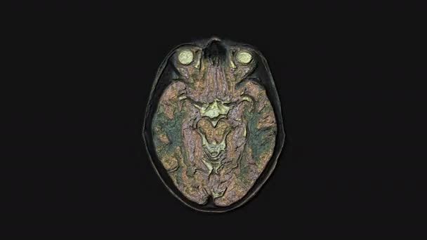 Massen bunte MRT Gehirn, Kopf-Scans und Tumor-Erkennung. Diagnostisches medizinisches Werkzeug - Filmmaterial, Video