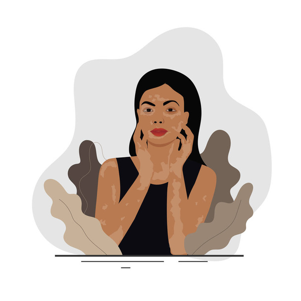 Woman with pale white vitiligo patches. Holding hand on her face. Beauty standards, health, skin conditions, dermatology and immune disease. Health problem, skin diseases. - Vector, Image