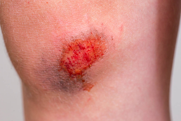 Детская травма. Глубокие царапины на коже с синяками на колене ребенка. Раны, царапины, ссадины на детской ноге - Фото, изображение
