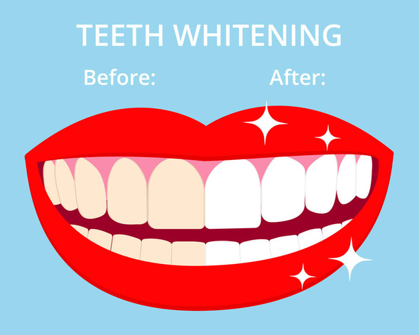 Teeth Whitening concept woth laughed mouse and teeth before and after bleaching. Vector isolated elements on blue background. EPS10 - Διάνυσμα, εικόνα
