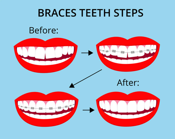 Stappen van beugels orthodontische behandeling op glimlach mond met witte tanden. Voor en na. Vector geïsoleerde elementen. EPS10 - Vector, afbeelding