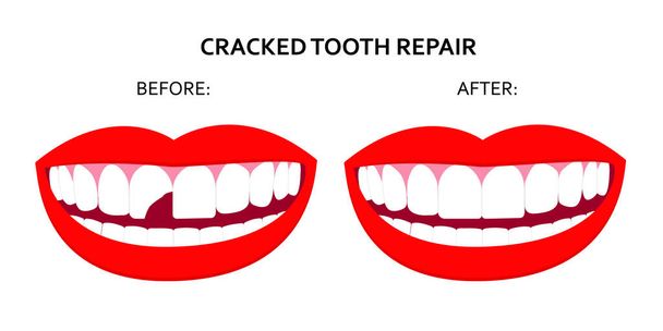 Ilustración de la reparación de dientes agrietados. Sonríe boca con el diente agrietado antes y después de la reparación. Vector aislado sobre fondo blanco. Bueno para carteles, pancartas. infografía. EPS10 - Vector, imagen