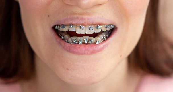 brasket system in smiling mouth, macro photo teeth, close-up lips, macro shot - Foto, afbeelding