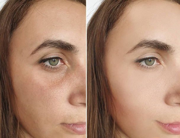 vrouw gezicht rimpels voor en na behandeling collage - Foto, afbeelding