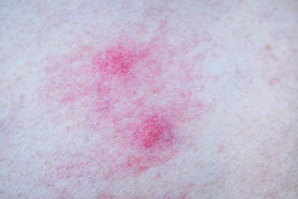 Alergia a la piel por picaduras de mosquitos - Foto, Imagen