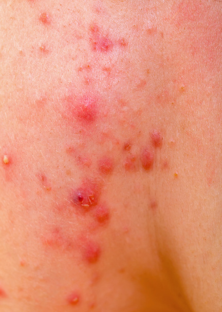 Acne skin - Photo, image