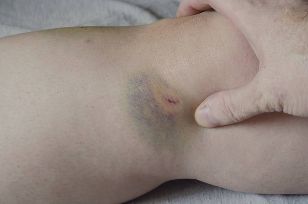 Hand indicates bruising and wounds to the female leg. Caucasian middle-aged woman shows hematoma and skin injuries. Domestic violence or an accident. - Photo, Image