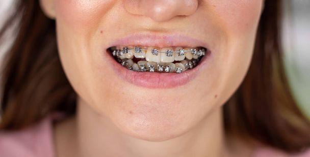 σύστημα brasket στο χαμογελαστό στόμα, μακροεντολή δόντια φωτογραφία, close-up χείλη, μακροεντολή shot. - Φωτογραφία, εικόνα