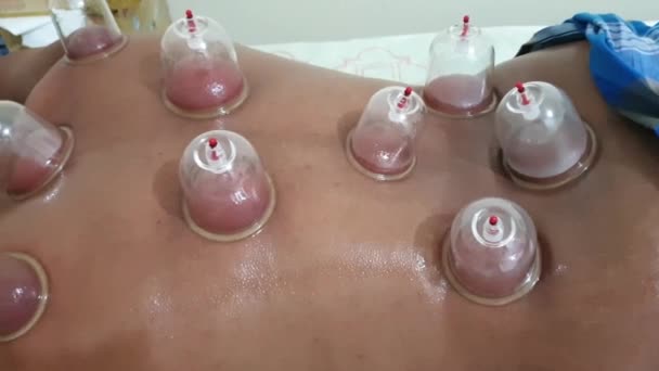 Background image of cupping done in a body. - Footage, Video