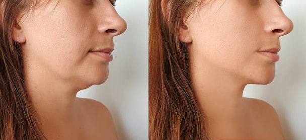женщина двойной подбородок до и после лечения - Фото, изображение