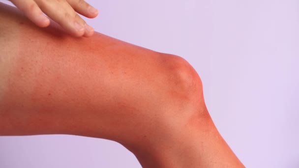 Leg of woman with red sunburned skin against color background - Footage, Video
